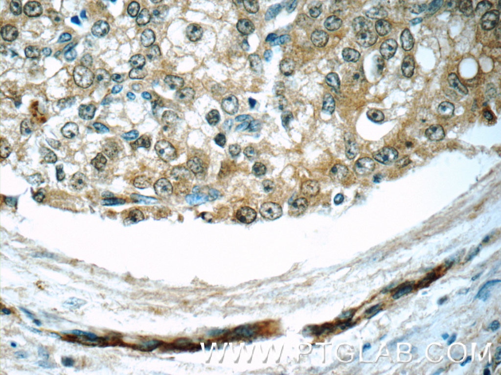 Immunohistochemistry (IHC) staining of human prostate cancer tissue using COPE Polyclonal antibody (11457-1-AP)