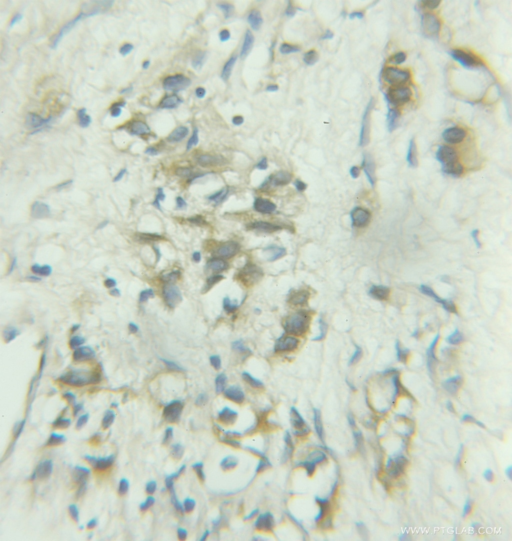 Immunohistochemistry (IHC) staining of human prostate cancer tissue using COPE Polyclonal antibody (11457-1-AP)