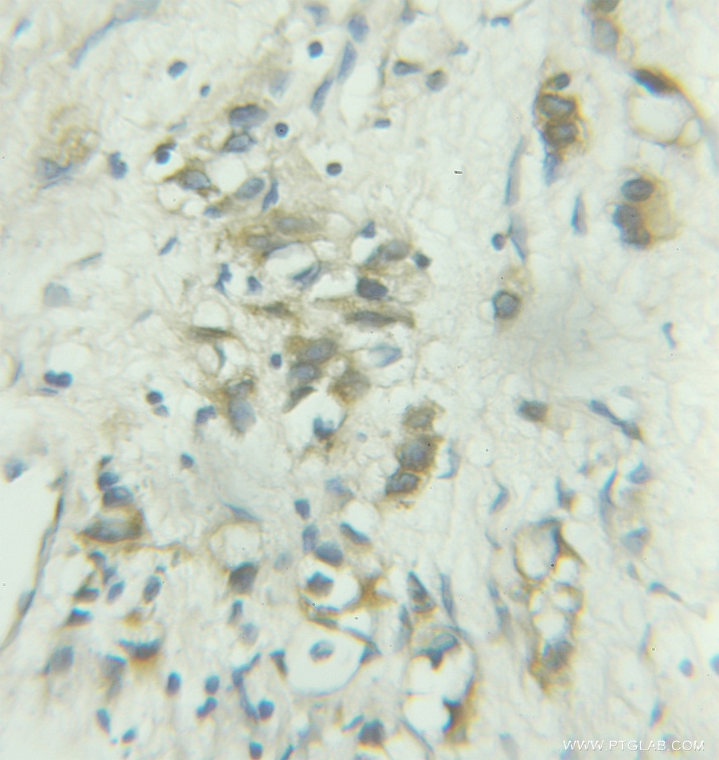 IHC staining of human prostate cancer using 11457-1-AP