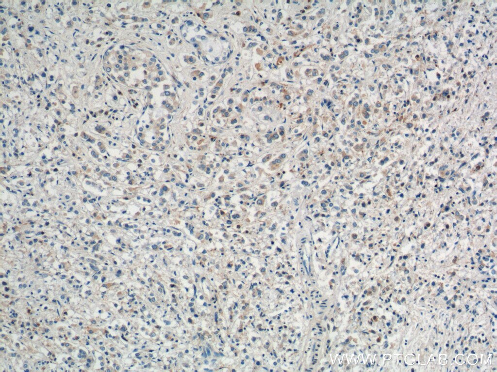 Immunohistochemistry (IHC) staining of human breast cancer tissue using COPG Polyclonal antibody (12393-1-AP)