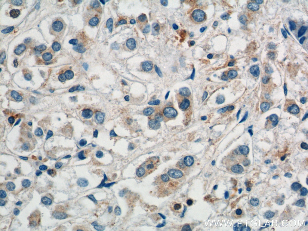 Immunohistochemistry (IHC) staining of human breast cancer tissue using COPG Polyclonal antibody (12393-1-AP)