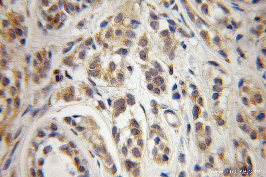 IHC staining of human breast cancer using 12393-1-AP