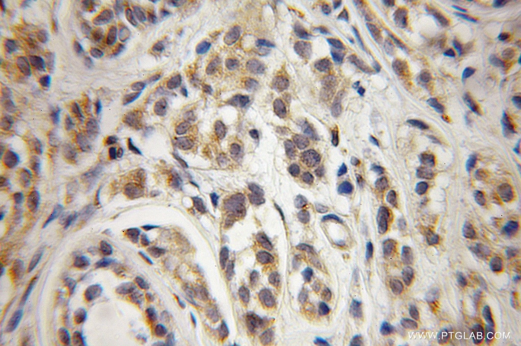 Immunohistochemistry (IHC) staining of human breast cancer tissue using COPG Polyclonal antibody (12393-1-AP)