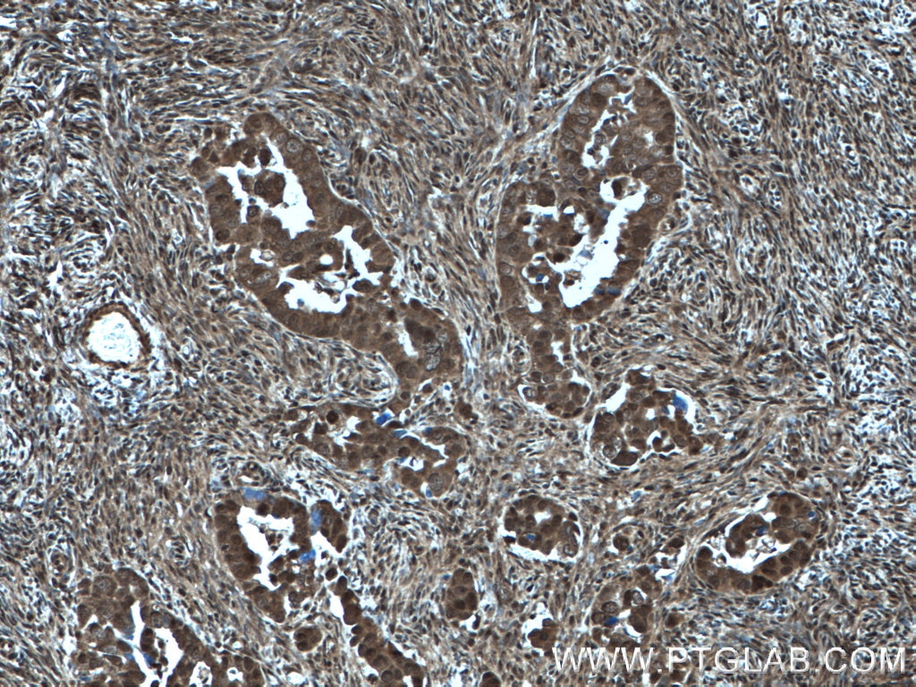 Immunohistochemistry (IHC) staining of human ovary tumor tissue using CSN2 Polyclonal antibody (10969-2-AP)