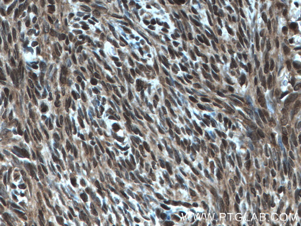 Immunohistochemistry (IHC) staining of human ovary tumor tissue using CSN2 Polyclonal antibody (10969-2-AP)