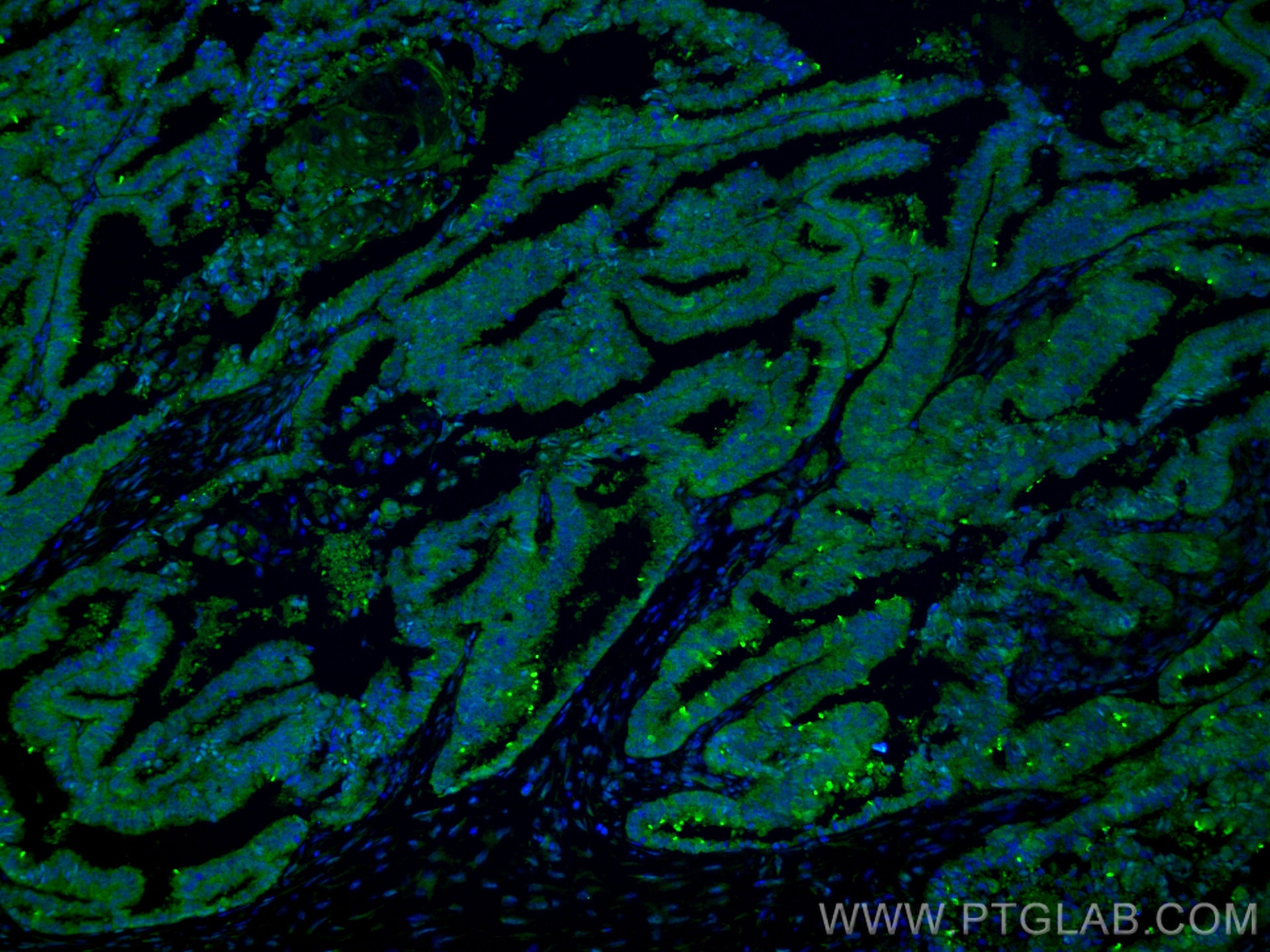 Immunofluorescence (IF) / fluorescent staining of human ovary tumor tissue using CSN2 Monoclonal antibody (66435-1-Ig)
