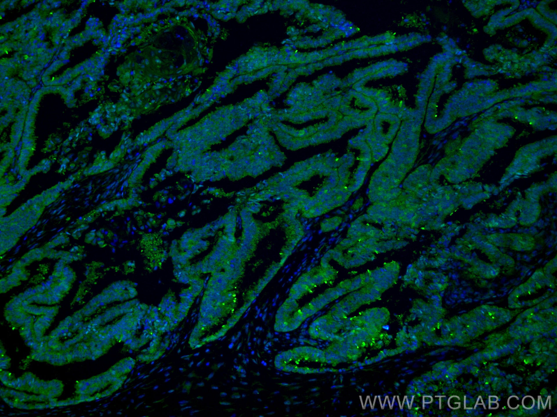 Immunofluorescence (IF) / fluorescent staining of human ovary tumor tissue using CSN2 Monoclonal antibody (66435-1-Ig)