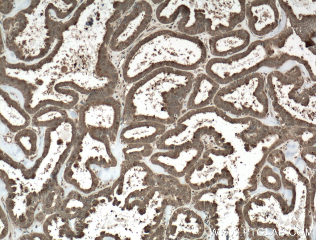 Immunohistochemistry (IHC) staining of human ovary tumor tissue using CSN2 Monoclonal antibody (66435-1-Ig)