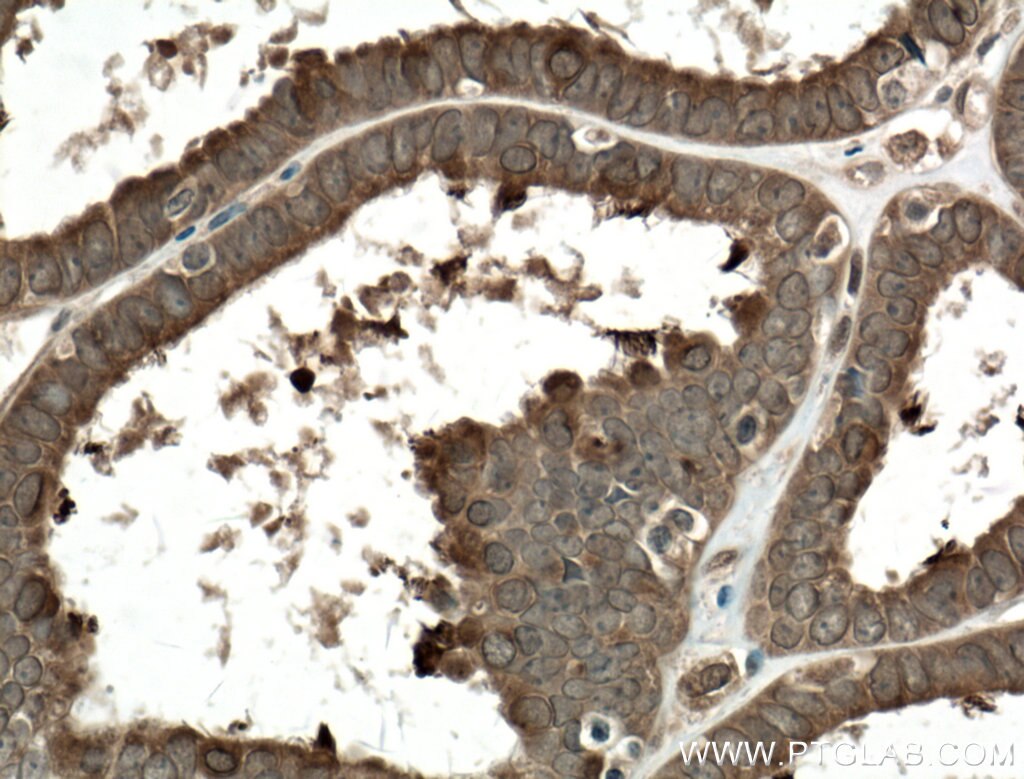 Immunohistochemistry (IHC) staining of human ovary tumor tissue using CSN2 Monoclonal antibody (66435-1-Ig)