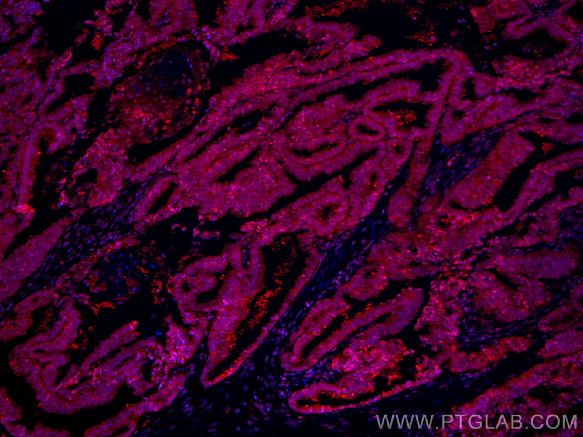 Immunofluorescence (IF) / fluorescent staining of human ovary cancer cells using CoraLite®594-conjugated COPS2 Monoclonal antibody (CL594-66435)