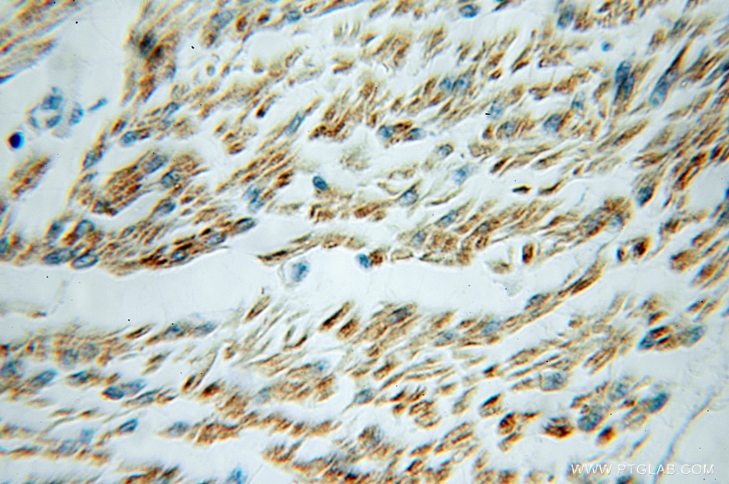 Immunohistochemistry (IHC) staining of human colon cancer tissue using COPS6 Polyclonal antibody (10256-1-AP)