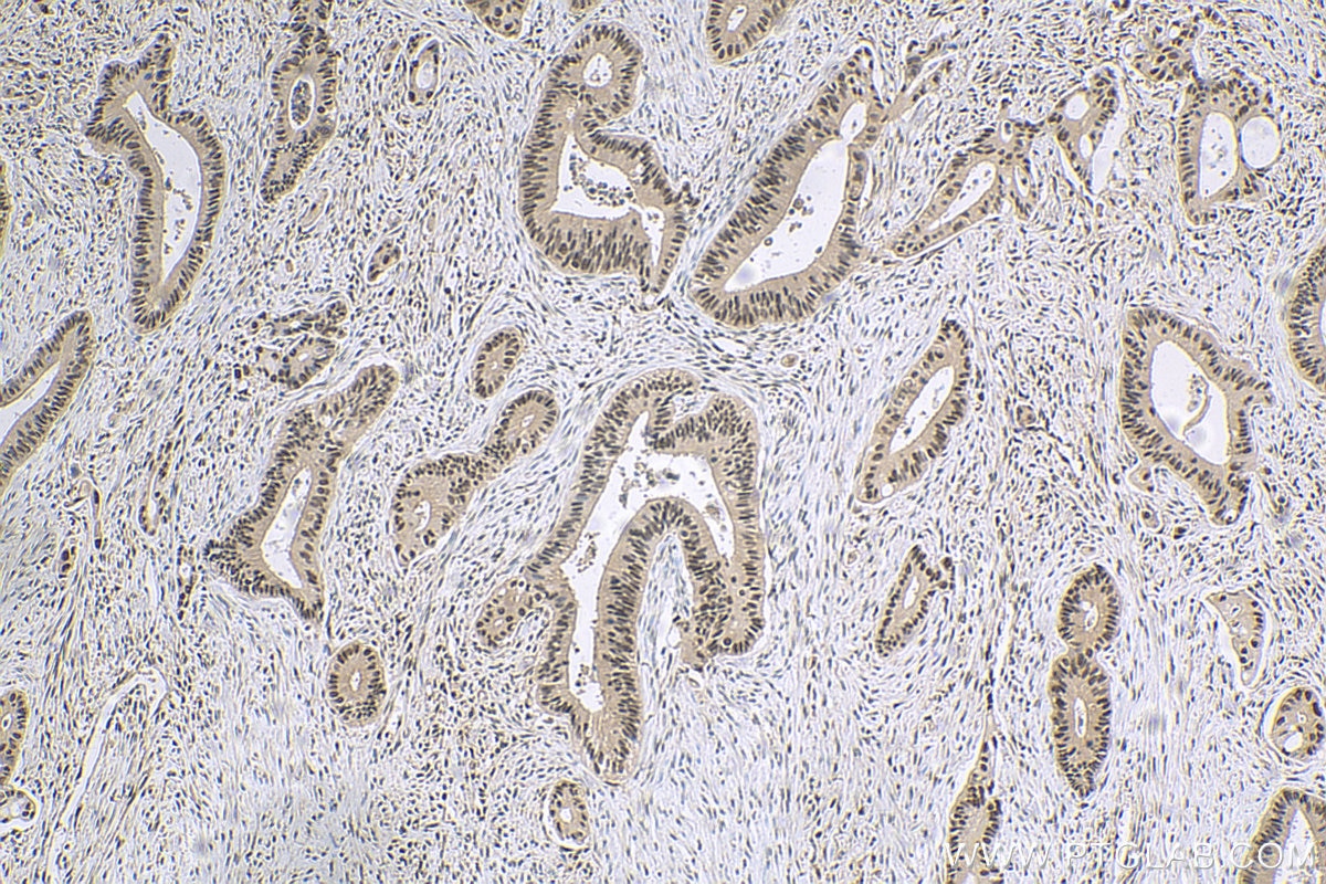 Immunohistochemistry (IHC) staining of human colon cancer tissue using COPS8/COP9 Polyclonal antibody (10089-2-AP)