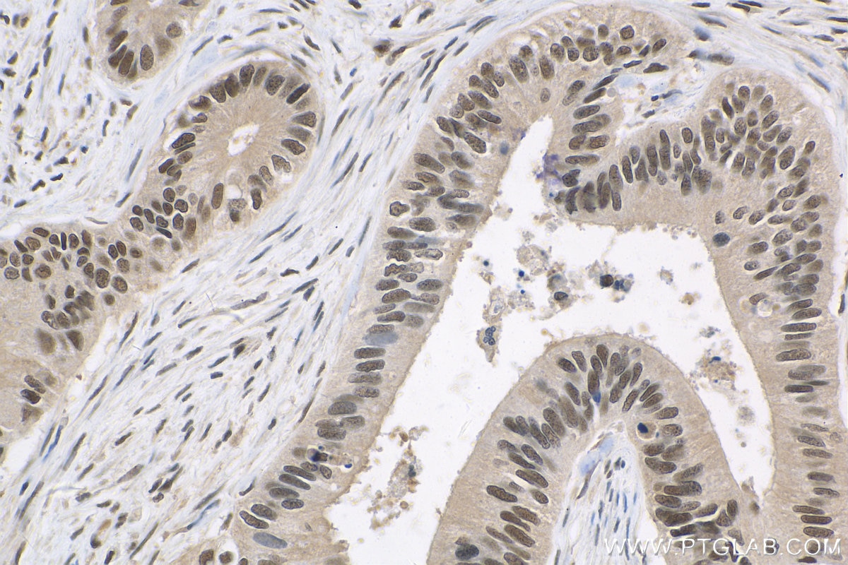 IHC staining of human colon cancer using 10089-2-AP