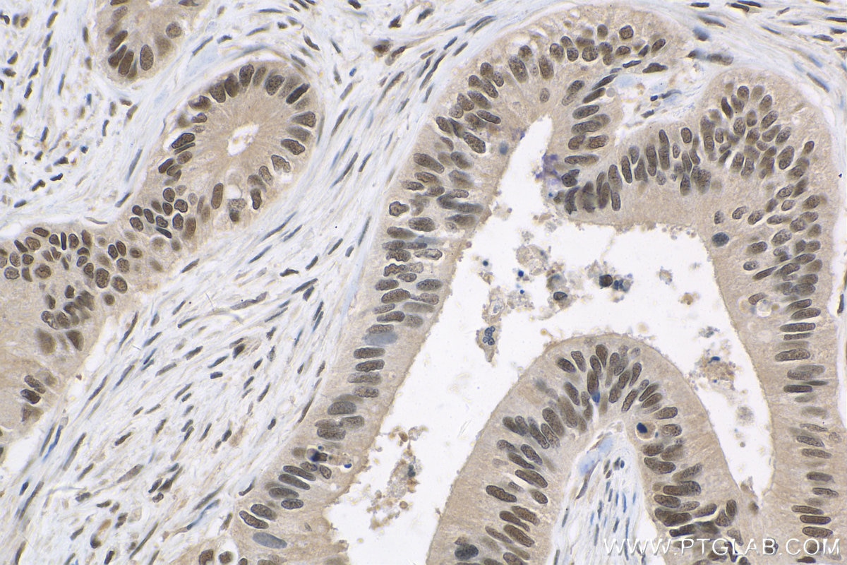 Immunohistochemistry (IHC) staining of human colon cancer tissue using COPS8/COP9 Polyclonal antibody (10089-2-AP)