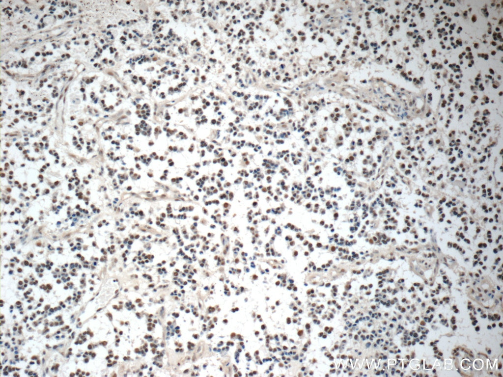 Immunohistochemistry (IHC) staining of human gliomas tissue using COPS8/COP9 Polyclonal antibody (10089-2-AP)