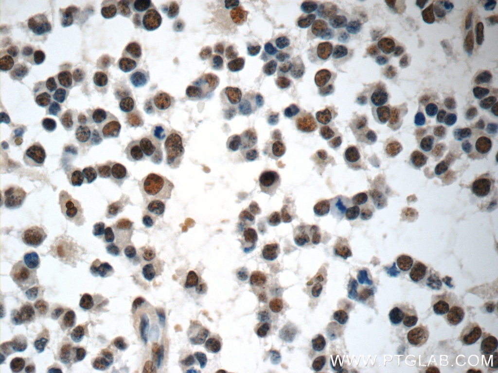 Immunohistochemistry (IHC) staining of human gliomas tissue using COPS8/COP9 Polyclonal antibody (10089-2-AP)