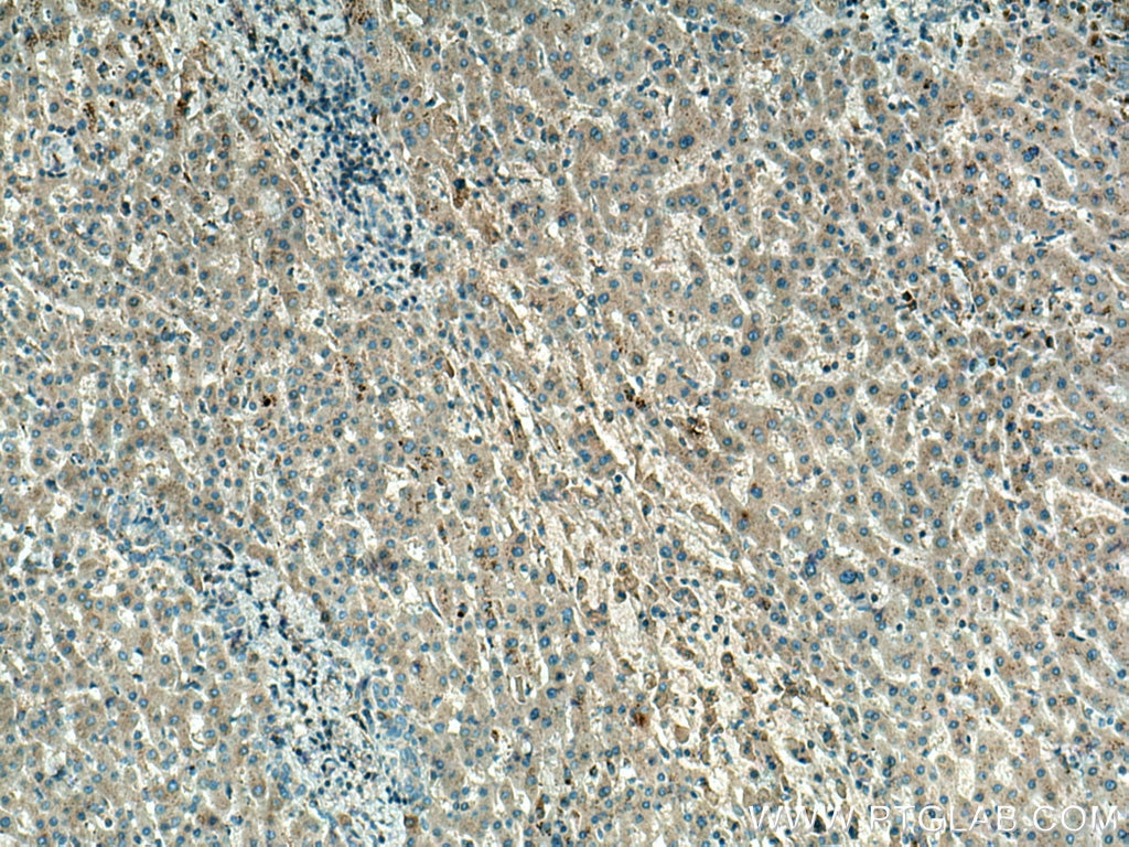 Immunohistochemistry (IHC) staining of human liver cancer tissue using COQ6 Monoclonal antibody (67162-1-Ig)