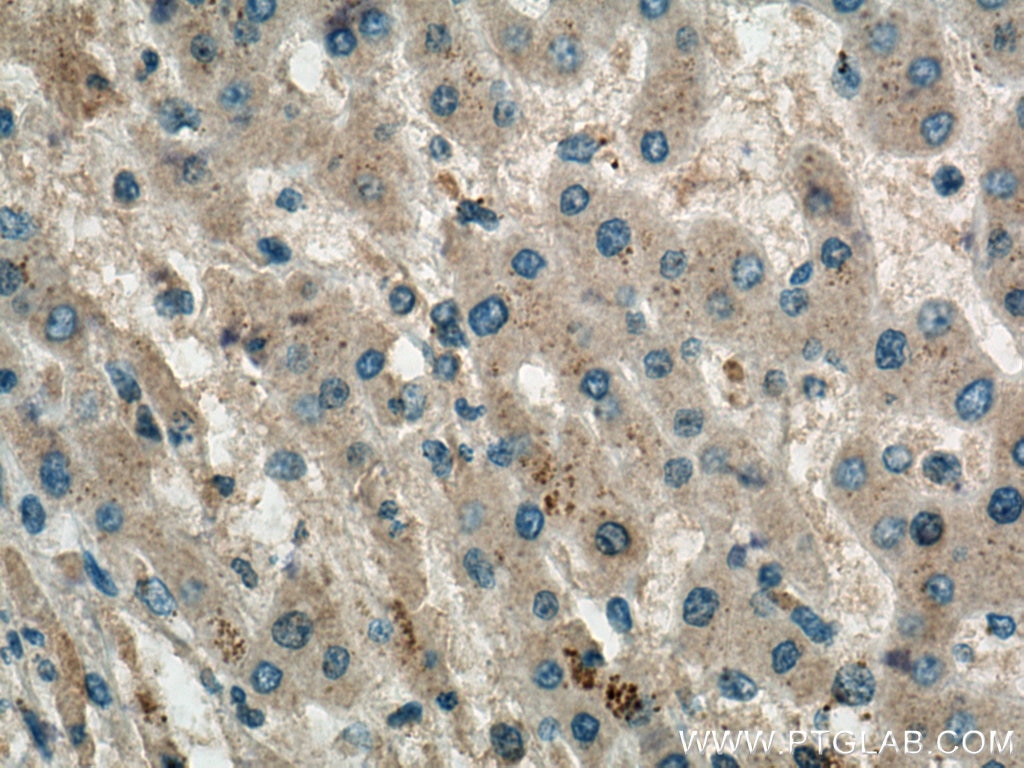 Immunohistochemistry (IHC) staining of human liver cancer tissue using COQ6 Monoclonal antibody (67162-1-Ig)