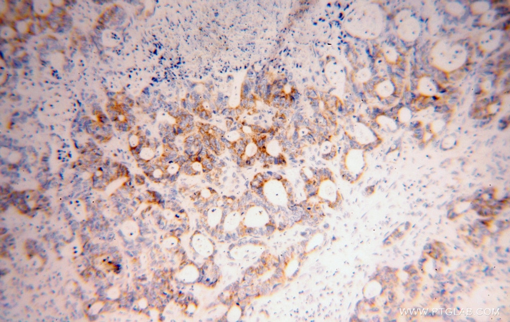 Immunohistochemistry (IHC) staining of human liver cancer tissue using COQ7 Polyclonal antibody (15083-1-AP)