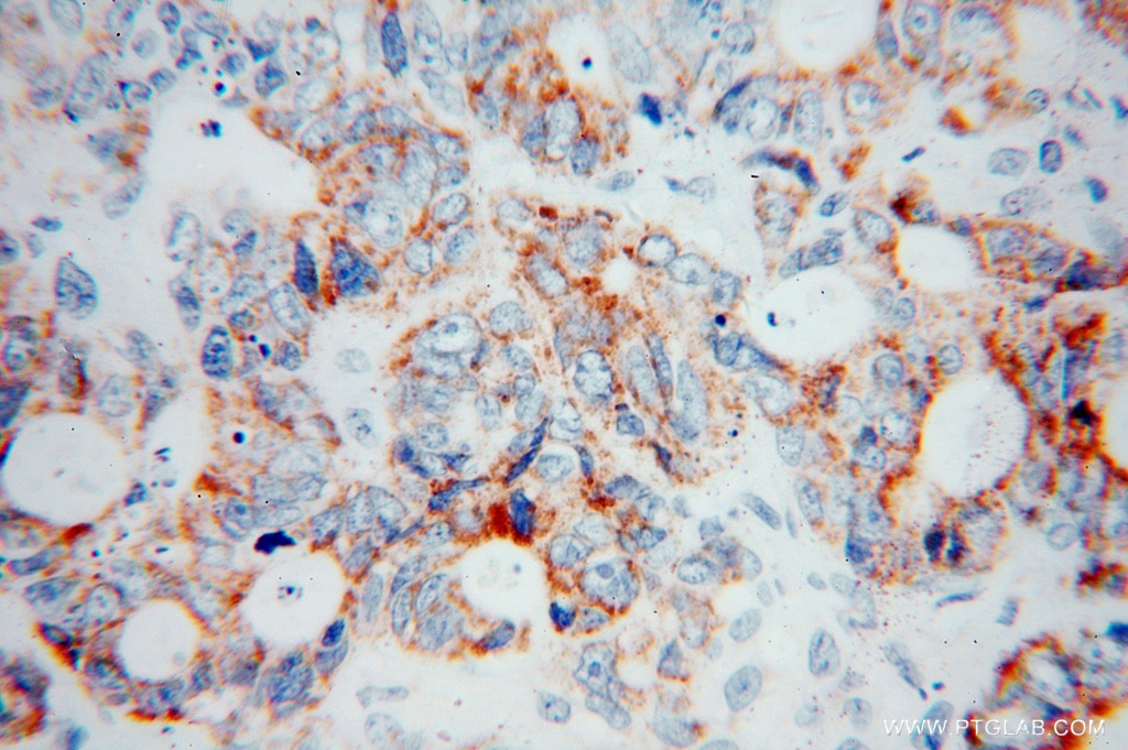 Immunohistochemistry (IHC) staining of human liver cancer tissue using COQ7 Polyclonal antibody (15083-1-AP)