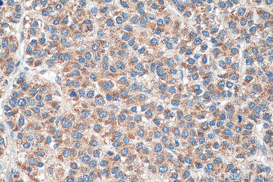 Immunohistochemistry (IHC) staining of human liver cancer tissue using COQ9 Polyclonal antibody (14874-1-AP)