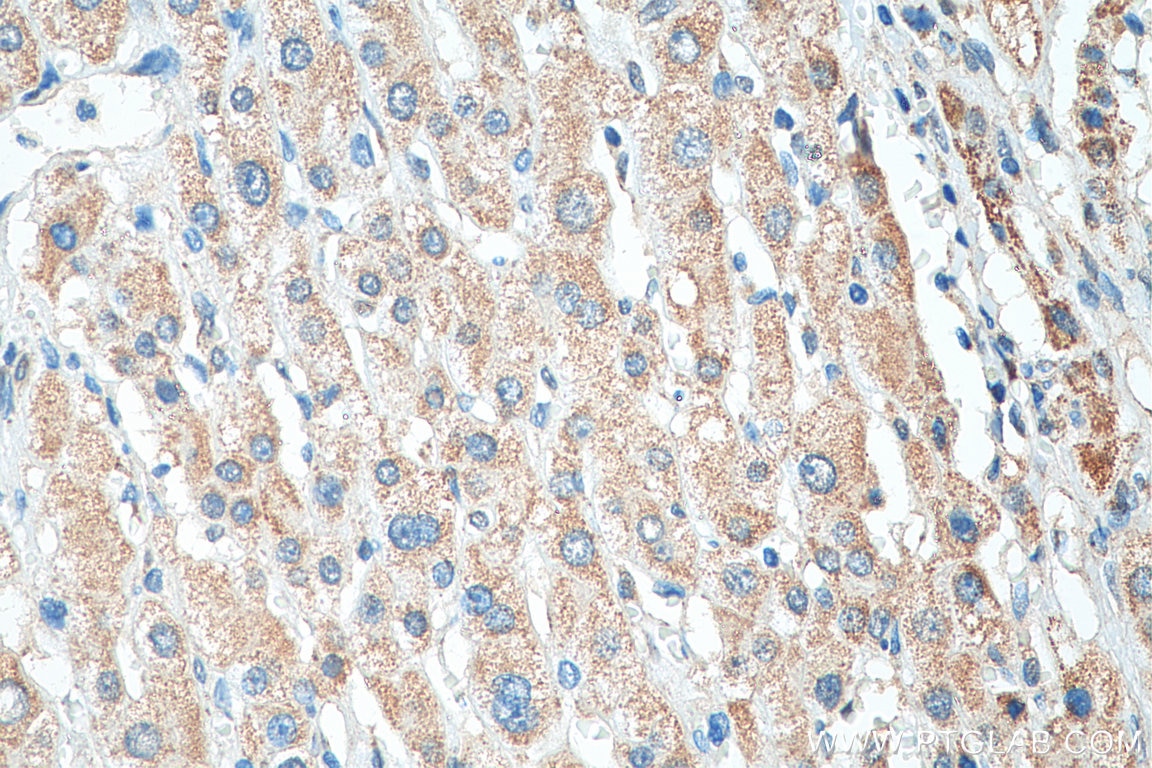 Immunohistochemistry (IHC) staining of human liver cancer tissue using COQ9 Polyclonal antibody (14874-1-AP)