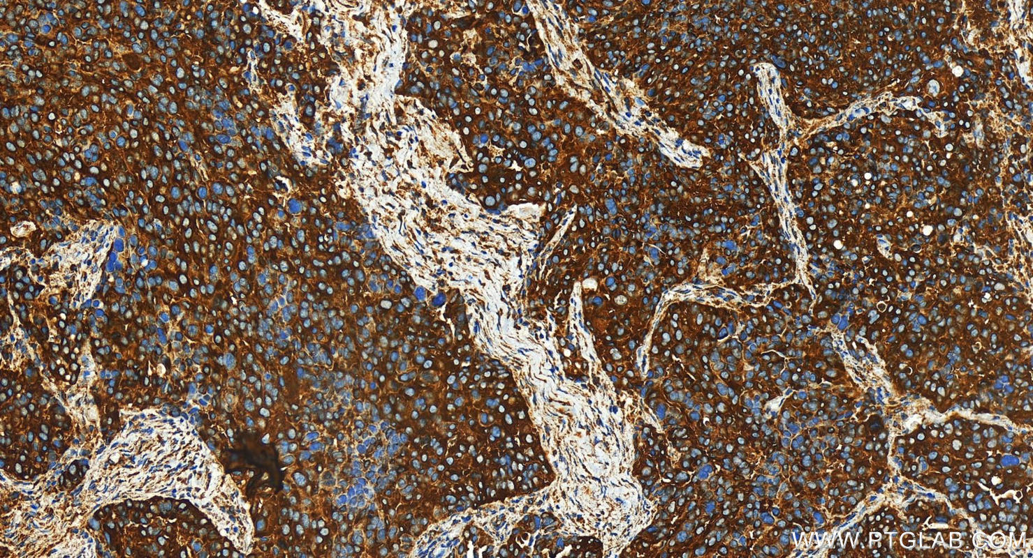 Immunohistochemistry (IHC) staining of human ovary cancer tissue using CORO1B Polyclonal antibody (31091-1-AP)