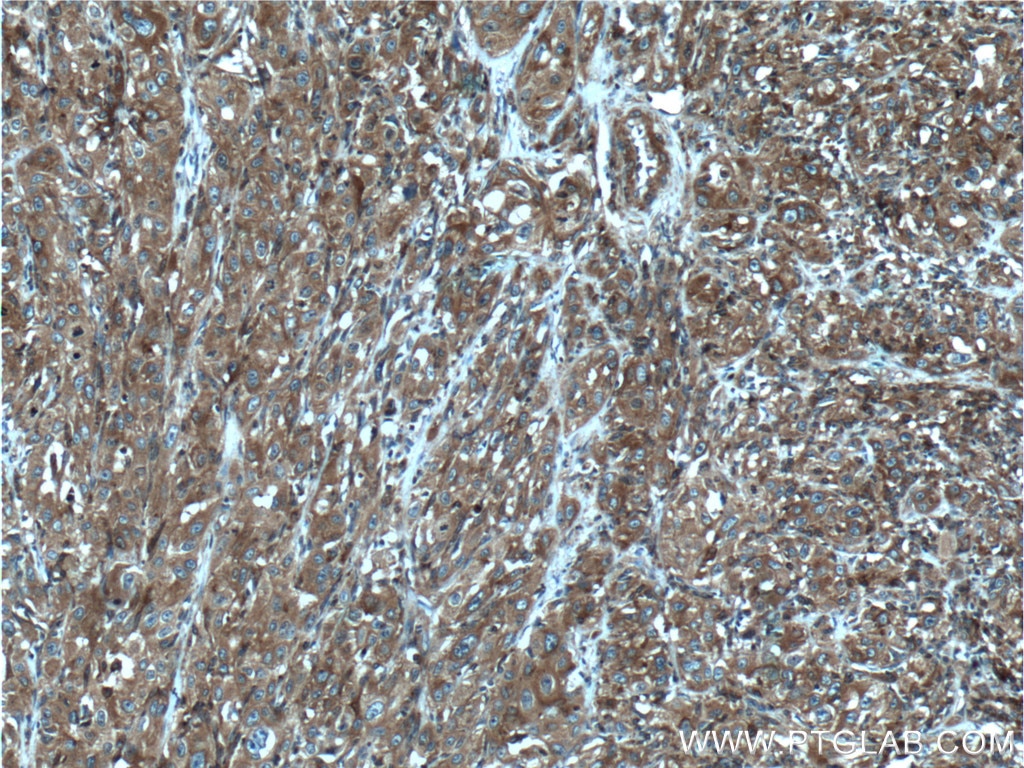 Immunohistochemistry (IHC) staining of human cervical cancer tissue using CORO1C Polyclonal antibody (14749-1-AP)