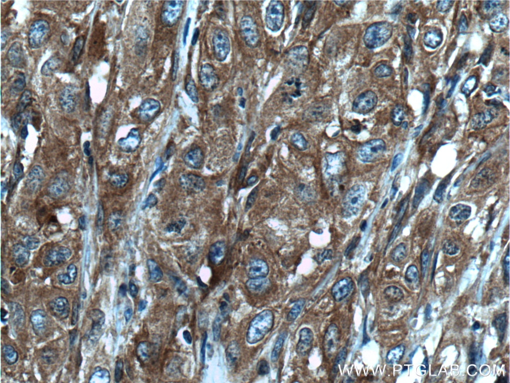 Immunohistochemistry (IHC) staining of human cervical cancer tissue using CORO1C Polyclonal antibody (14749-1-AP)