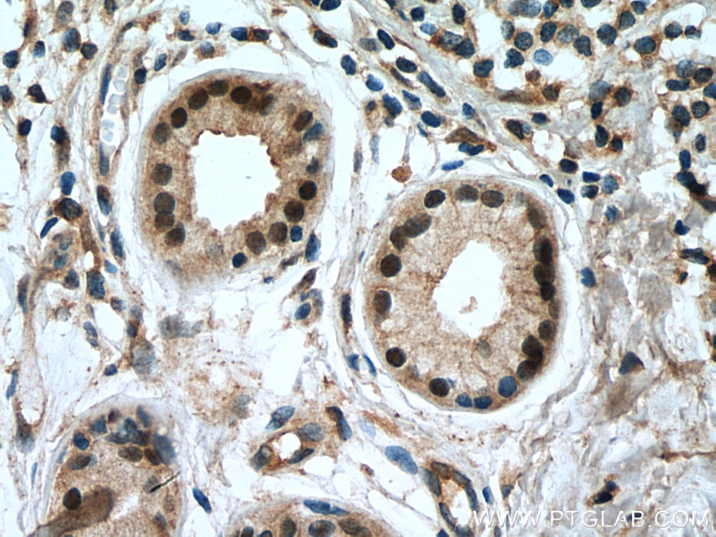 Immunohistochemistry (IHC) staining of human skin cancer tissue using CORO2A Polyclonal antibody (10119-1-AP)