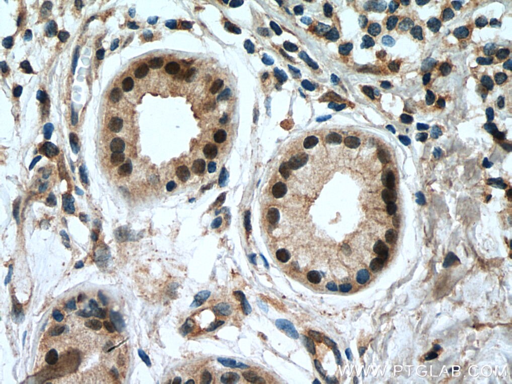 IHC staining of human skin cancer using 10119-1-AP