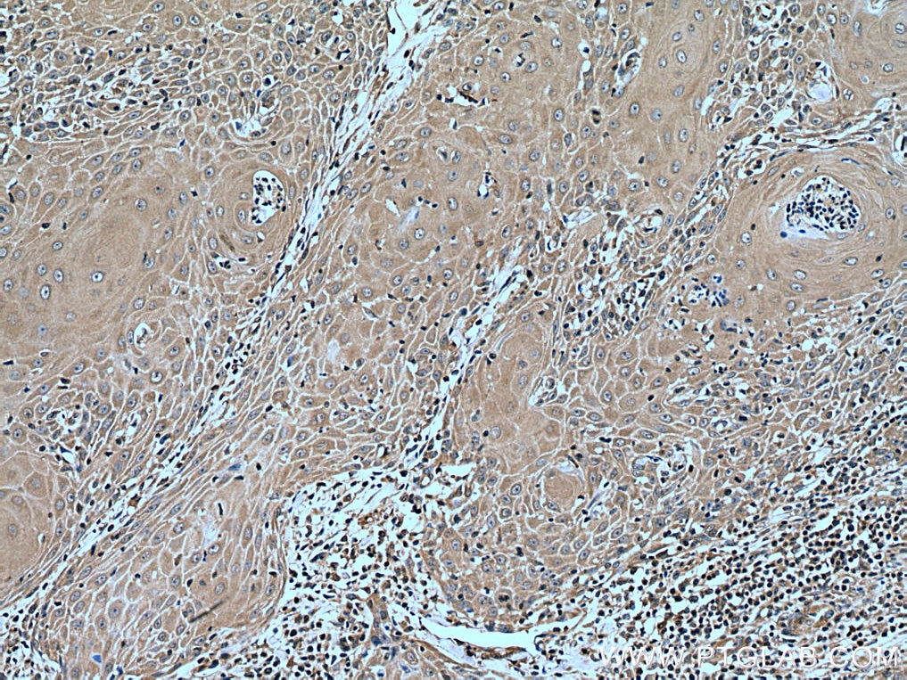 IHC staining of human skin cancer using 28883-1-AP