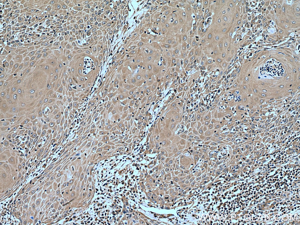 Immunohistochemistry (IHC) staining of human skin cancer tissue using CORO2A Polyclonal antibody (28883-1-AP)