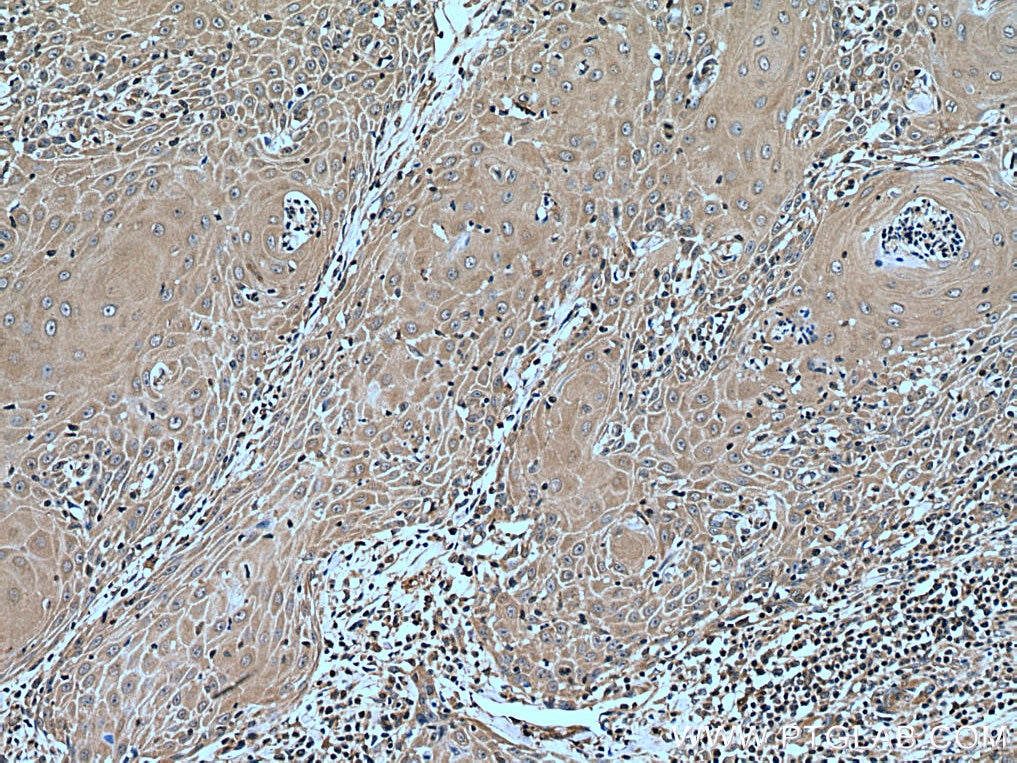 Immunohistochemistry (IHC) staining of human skin cancer tissue using CORO2A Polyclonal antibody (28883-1-AP)