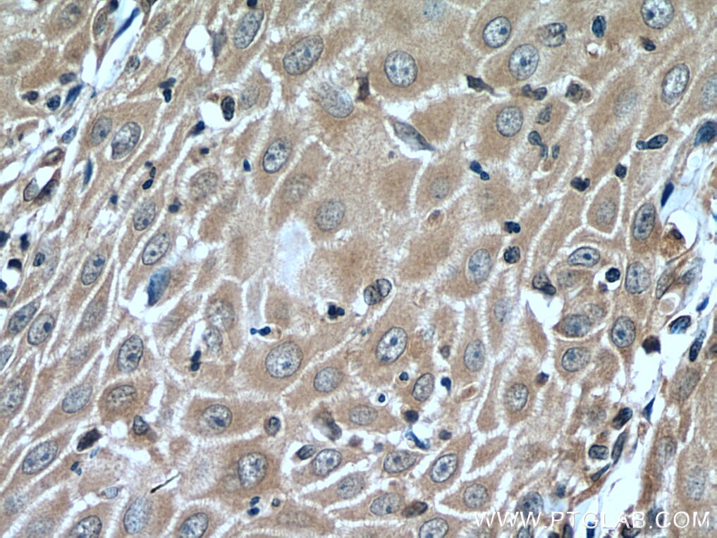 Immunohistochemistry (IHC) staining of human skin cancer tissue using CORO2A Polyclonal antibody (28883-1-AP)
