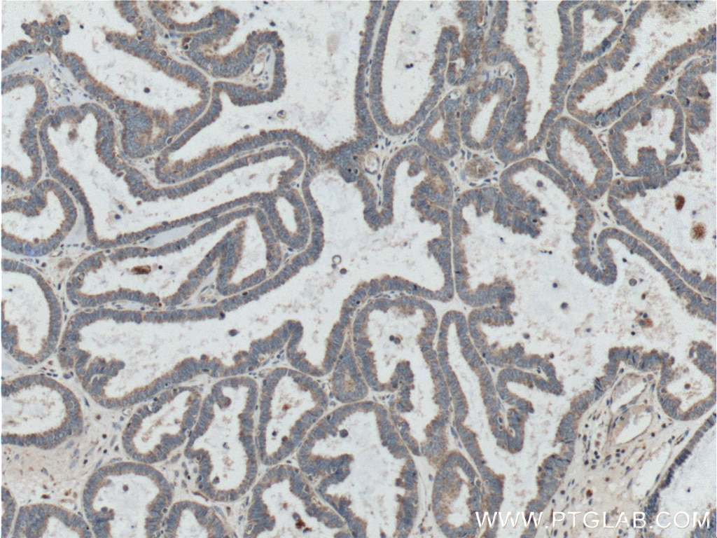Immunohistochemistry (IHC) staining of human ovary tumor tissue using CORO2B Polyclonal antibody (13802-1-AP)