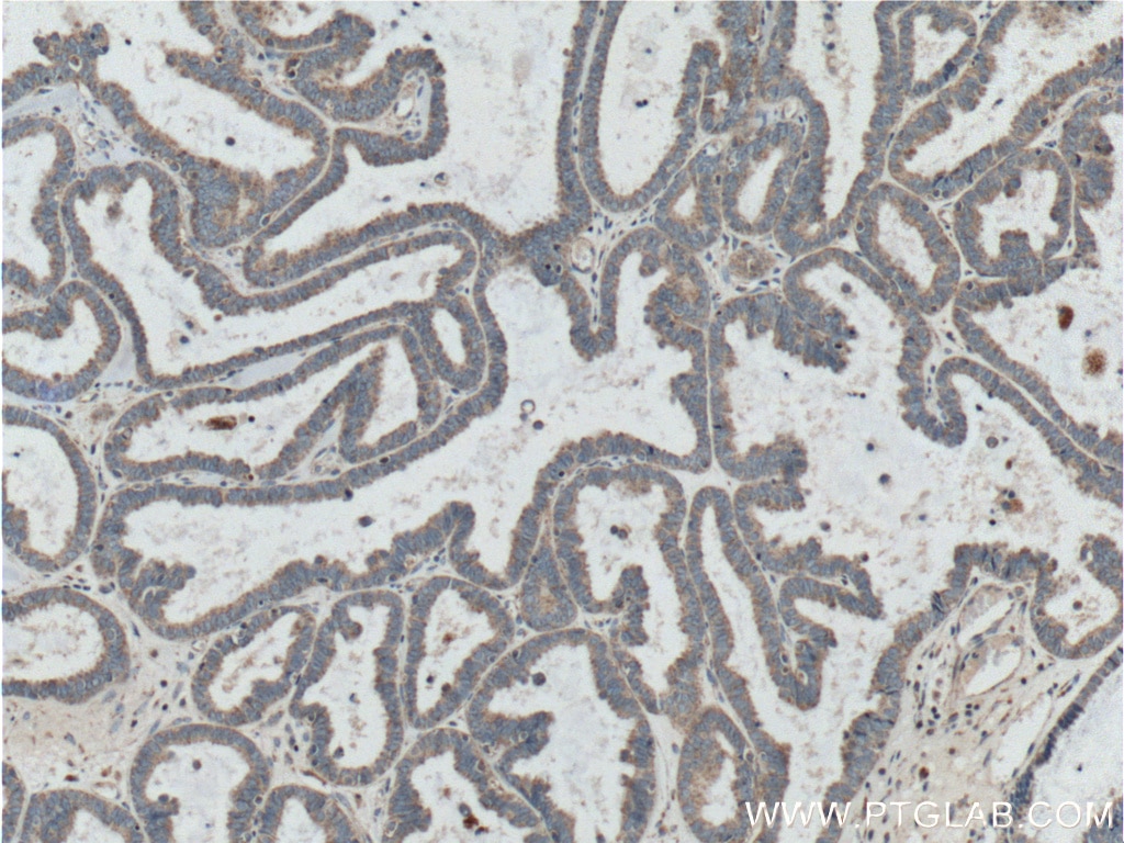 IHC staining of human ovary tumor using 13802-1-AP