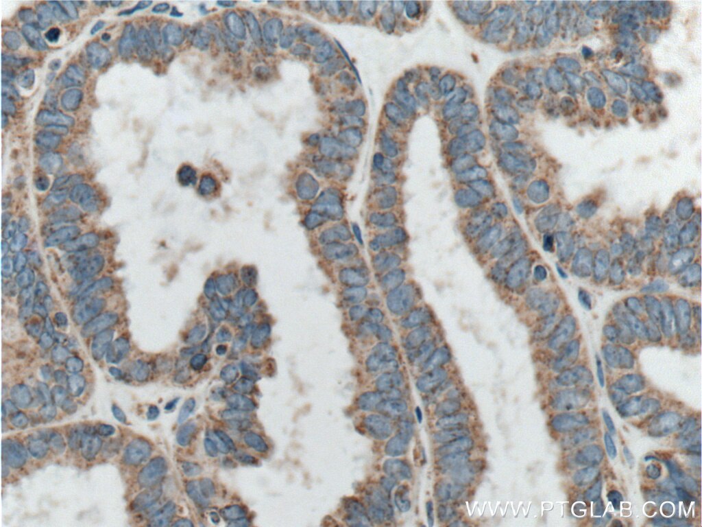 Immunohistochemistry (IHC) staining of human ovary tumor tissue using CORO2B Polyclonal antibody (13802-1-AP)