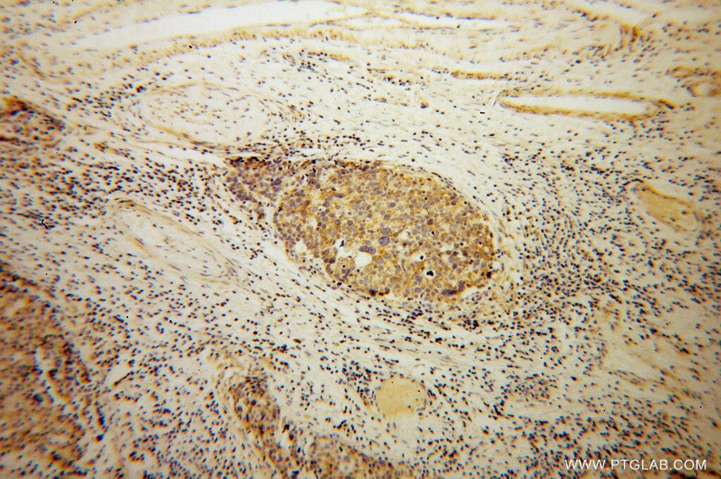 Immunohistochemistry (IHC) staining of human ovary tumor tissue using CORO2B Polyclonal antibody (13802-1-AP)