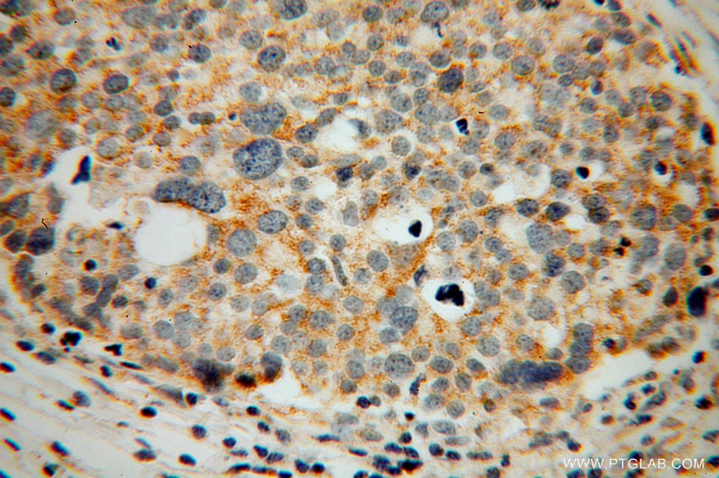 Immunohistochemistry (IHC) staining of human ovary tumor tissue using CORO2B Polyclonal antibody (13802-1-AP)