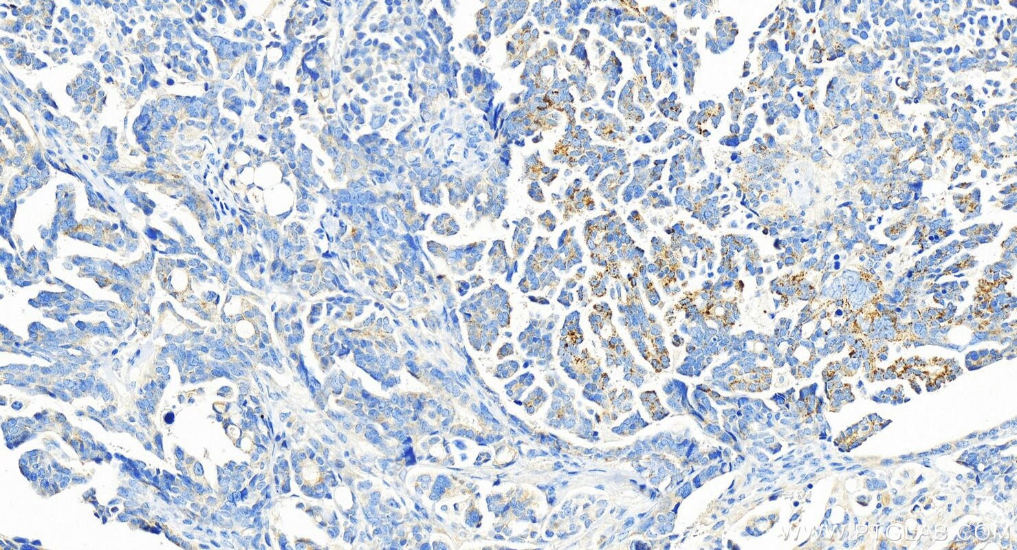 Immunohistochemistry (IHC) staining of human ovary cancer tissue using CORO2B Polyclonal antibody (13802-1-AP)