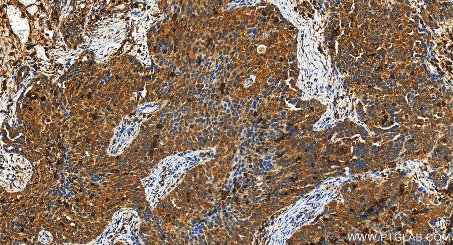 Immunohistochemistry (IHC) staining of human ovary cancer tissue using CORO7 Polyclonal antibody (31425-1-AP)