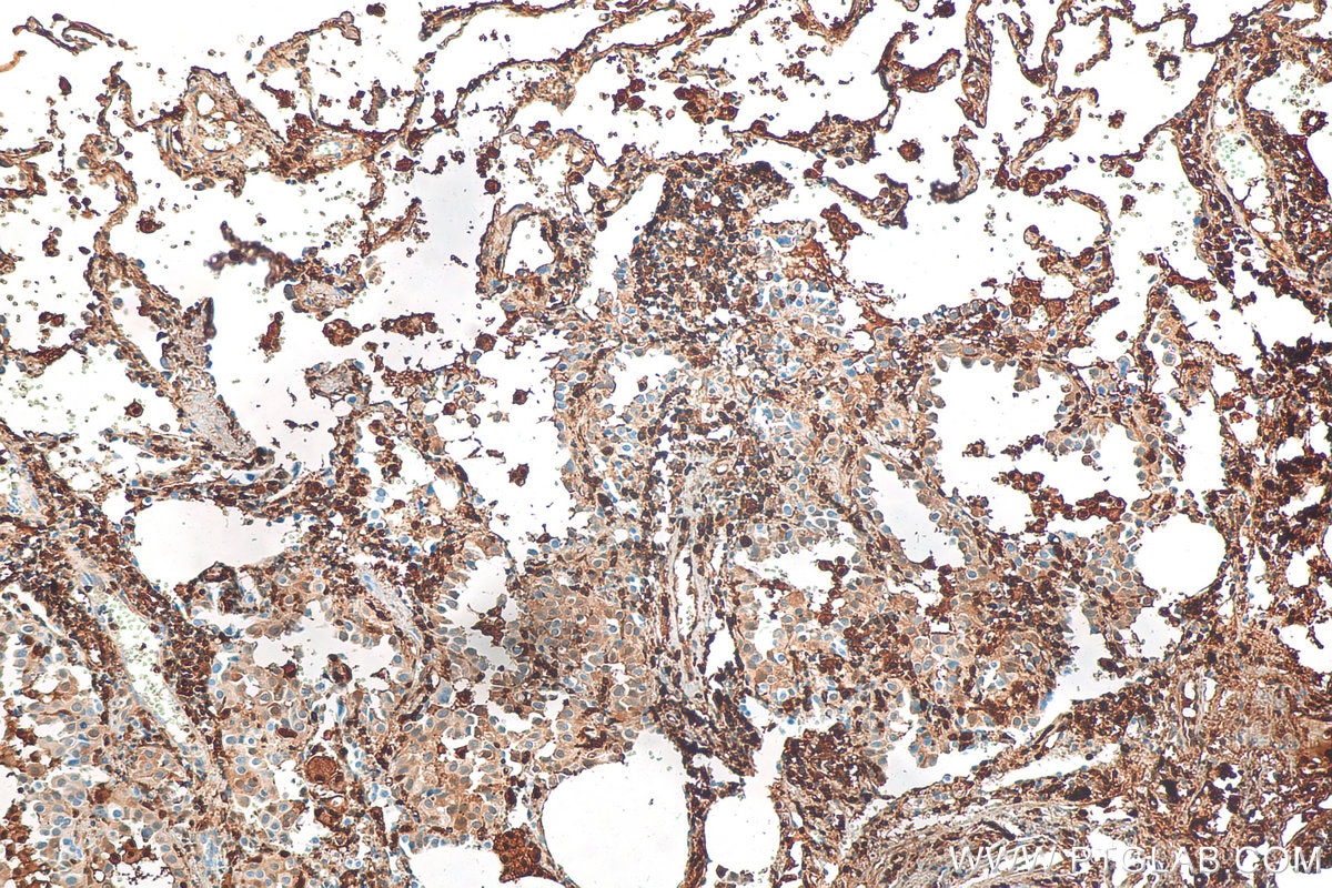 Immunohistochemistry (IHC) staining of human lung cancer tissue using COTL1 Polyclonal antibody (10781-1-AP)