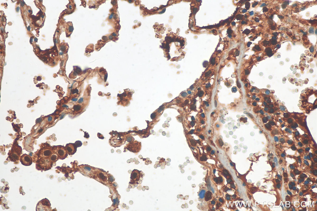 Immunohistochemistry (IHC) staining of human lung cancer tissue using COTL1 Polyclonal antibody (10781-1-AP)