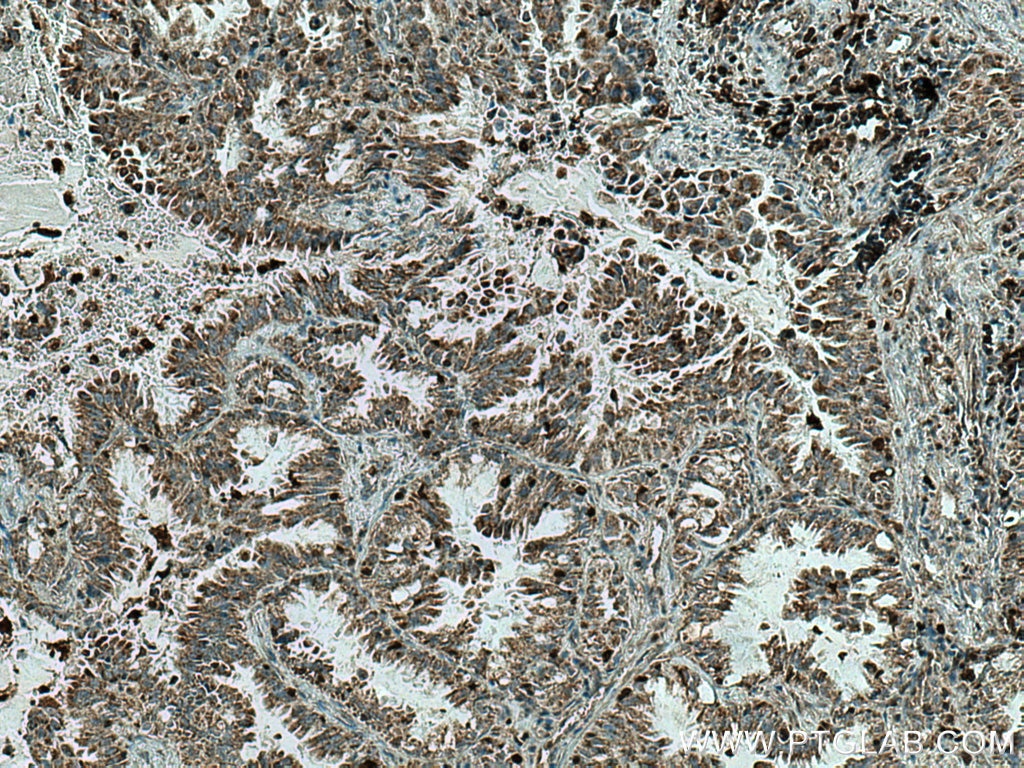 Immunohistochemistry (IHC) staining of human lung cancer tissue using COTL1 Monoclonal antibody (60237-1-Ig)