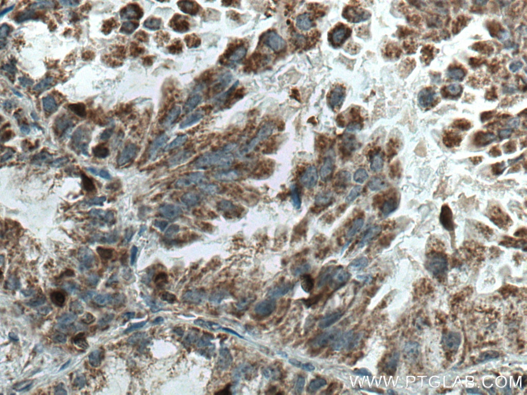 Immunohistochemistry (IHC) staining of human lung cancer tissue using COTL1 Monoclonal antibody (60237-1-Ig)