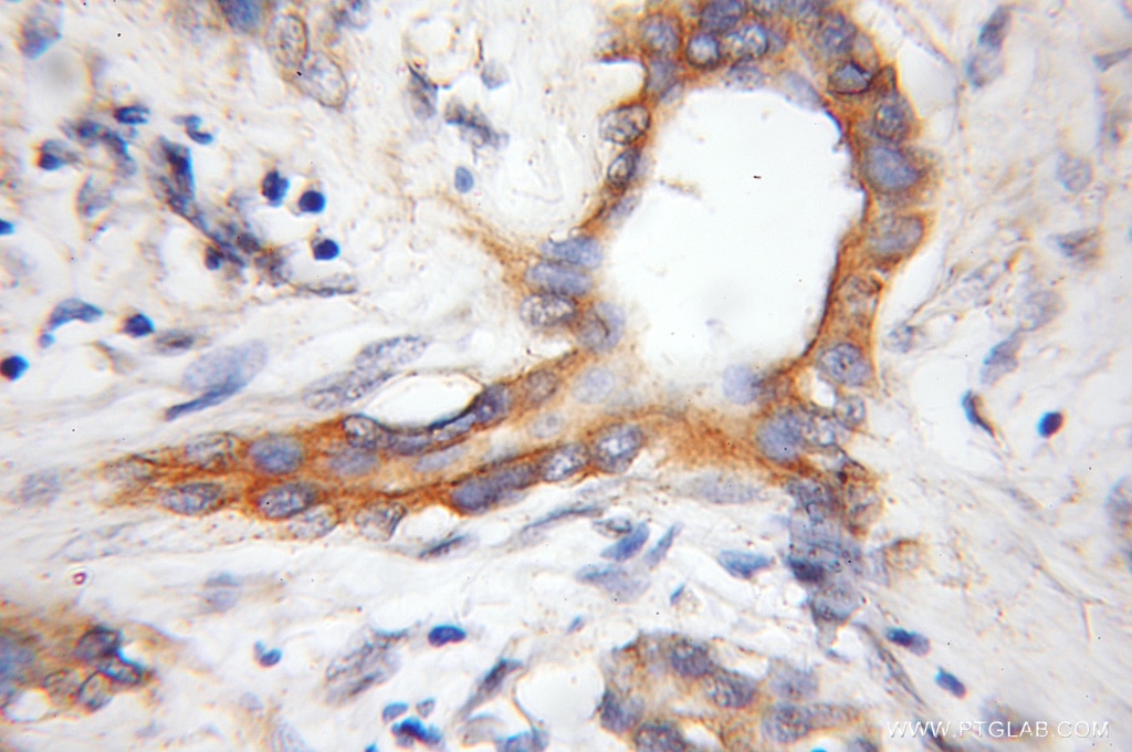 Immunohistochemistry (IHC) staining of human pancreas cancer tissue using COX11 Polyclonal antibody (11498-1-AP)