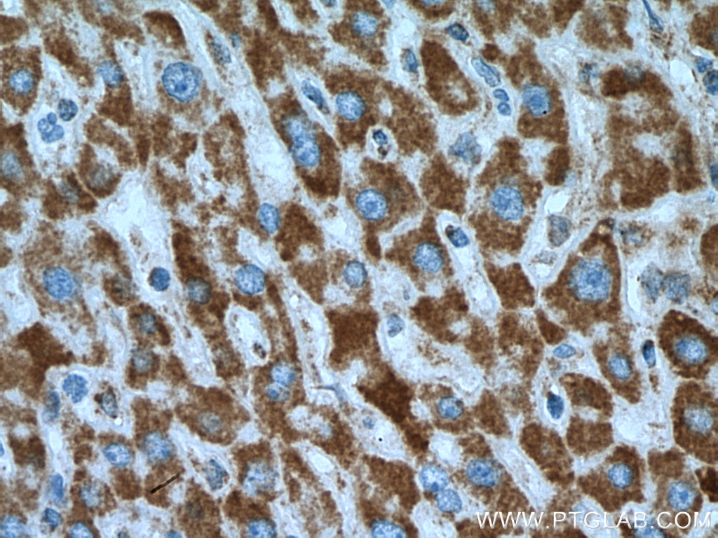 Immunohistochemistry (IHC) staining of human liver cancer tissue using COX17 Polyclonal antibody (11464-1-AP)