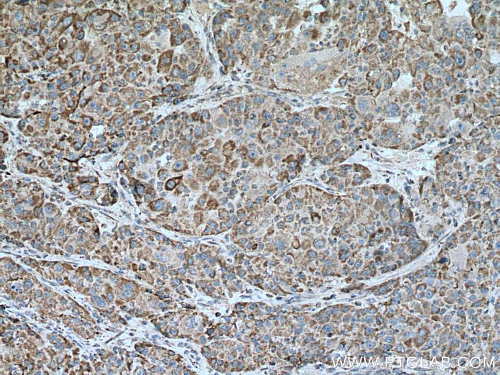 Immunohistochemistry (IHC) staining of human liver cancer tissue using COX17 Polyclonal antibody (11464-1-AP)
