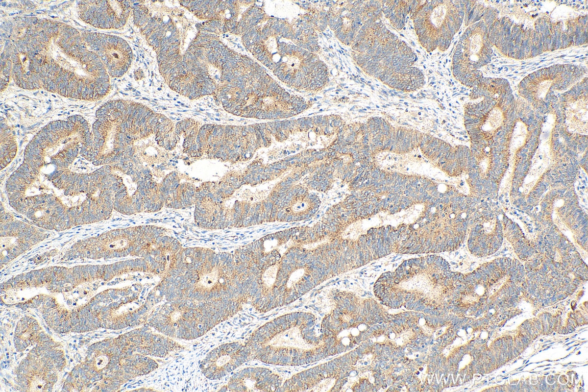 Immunohistochemistry (IHC) staining of human colon cancer tissue using COX19 Polyclonal antibody (31226-1-AP)